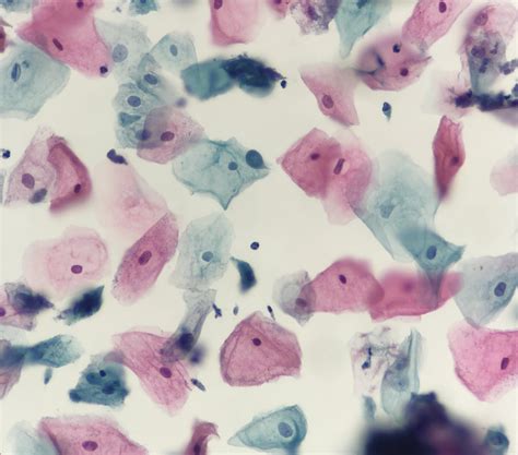 O'que é Trichomonas Vaginalis