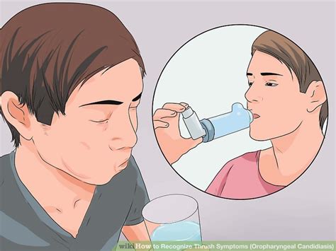 3 Ways To Recognize Thrush Symptoms Oropharyngeal Candidiasis