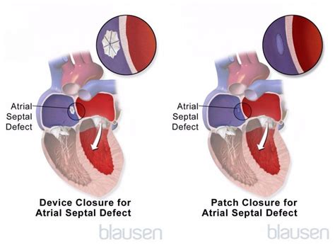 Atrial And Ventricular Septal Defects Childrens Health Issues Msd