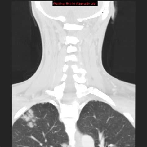 Tuberculosis Cervical Lymph Nodes And Lung Image