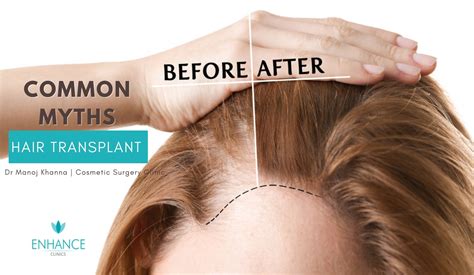 4 Common Myths On Hair Transplant Which You Need To Debunk Plastic