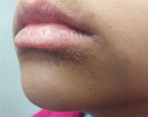 small pimples near lips