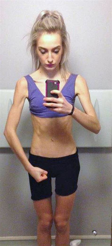 Dancer Who Battled Anorexia Reveals Incredible Recovery Pictures And How She Rebuilt