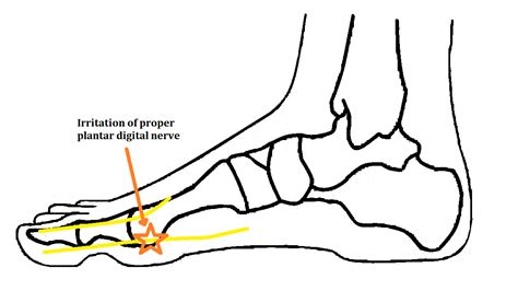 Joplins Neuritis Ankle Foot And Orthotic Centre