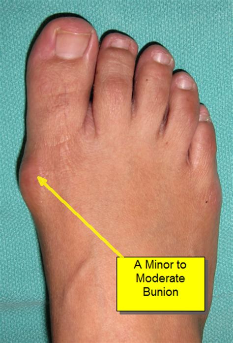 Bunion Surgery Before And After Pictures Best Podiatrist Nyc