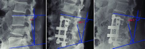 X Ray Lumbar Spine Lateral View In A 42 Year Old Woman Showing L4 Burst