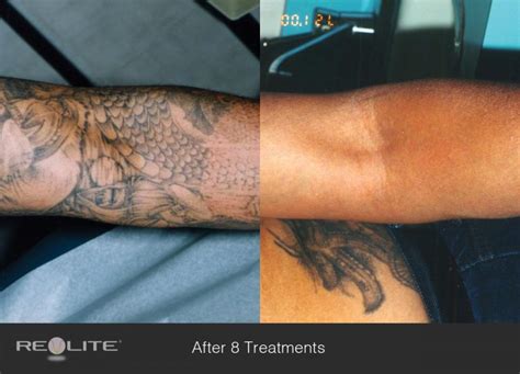 Tattoo Removal Dermatology And Laser Centre Of Los Angeles
