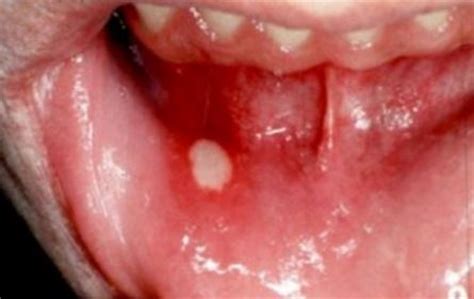 Questions about bumps in mouths are very common ones so he and his team put together a list of the 12 most common causes, symptoms and a guideline to while many bumps on the roof of the mouth will resolve without treatment, some may require medical intervention. Pimple on roof of mouth | XXX Porn Library