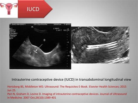 Role Of Ultrasound In The Assessment Of Intrauterine Contraceptive