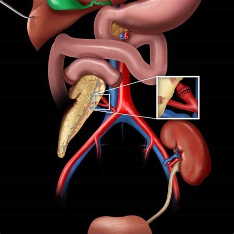 Pancreatic Transplantation Radiology Key