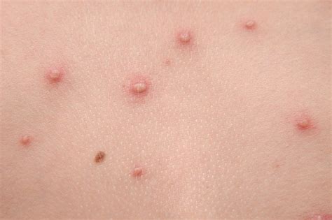 Small Red Spots On Skin Nhs Jameslemingthon Blog