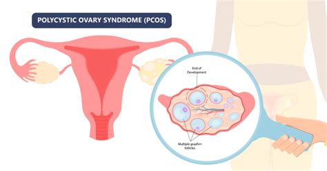 A Primer On Polycystic Ovary Syndrome Pcos Tryon Medical Partners