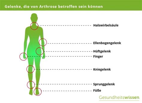 Arthrose Anzeichen Ursachen And Behandlung Der Volkskrankheit