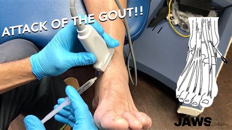 Injecting A Gouty Ankle Joint Youtube