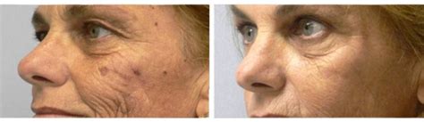 Clearlift Laser Skin By Design Dermatology And Laser Center Pa
