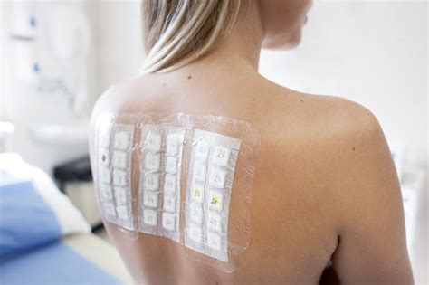 Atopy Patch Test With Aeroallergens For Allergen Diagnosis In Patients