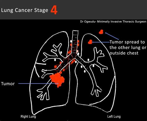 Lung Cancer Lung Cancer Life Expectancy