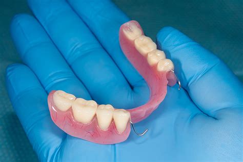Partials In Southaven Ms Desoto Dentures And Implants Partials In