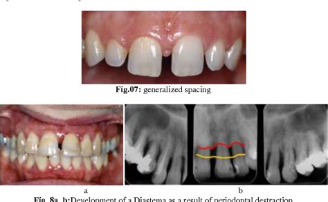 Figure 8 From Maxillary Midline Diastema Aetiology And Orthodontic