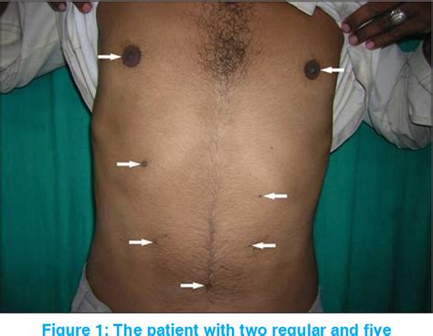 Figure From Seven Nipples In A Male World S Second Case Report Semantic Scholar