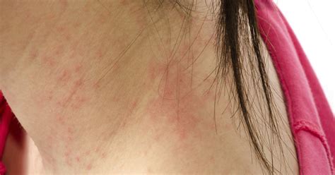 Red Bumps In The Nape Of The Scalp Livestrongcom