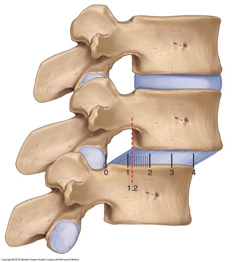 Spondylolisthesis — Experience Physical Therapy Buffalo Grove Il