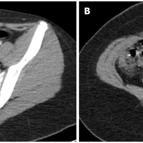 Terminal Ileitis In The Setting Of Multisystem Inflammatory Syndrome In