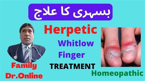 Herpetic Whitlow Finger Treatment In Homeopathic Youtube
