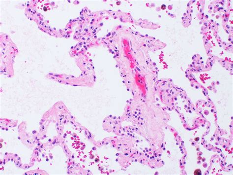 Pulmonary veno-occlusive disease | Flickr - Photo Sharing!