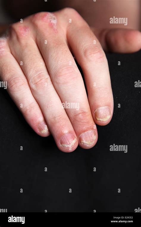 Psoriasis Nails Fotografías E Imágenes De Alta Resolución Alamy