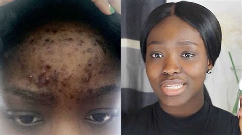 How To Clear Acne On A Budget Real Life Quick Results Youtube