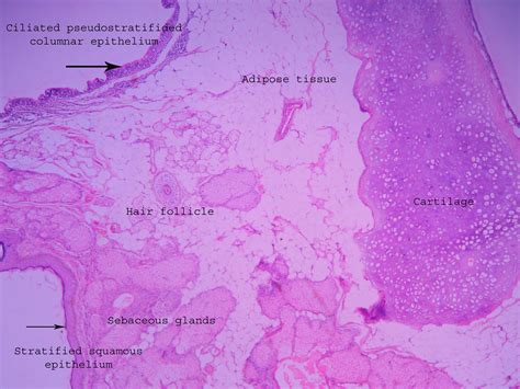 Dermoid Cyst Ovary Histopathologyguru