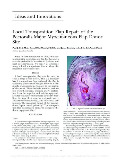 PDF Ideas And Innovations Local Transposition Flap Repair Of