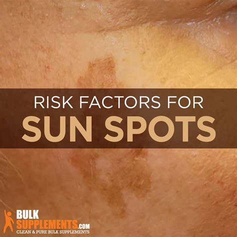 What Are Sunspots Symptoms Causes And Treatment