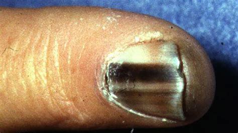 Black Spot Under Toenail Melanoma Nail Ftempo