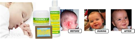 Baby Eczema Treatment Package