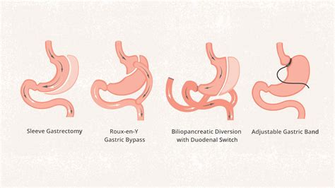 Bariatric Surgery How It Works Benefits Foods And More