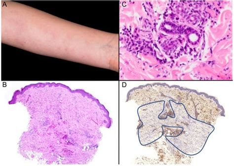 Dermatopathology Free Full Text Loss Of Cd34 Expression Within An