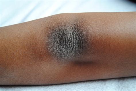 Three Simple Ways Of Removing Dry And Dark Skin On The Elbows Healthy