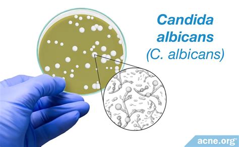 Can Candida Cause Acne