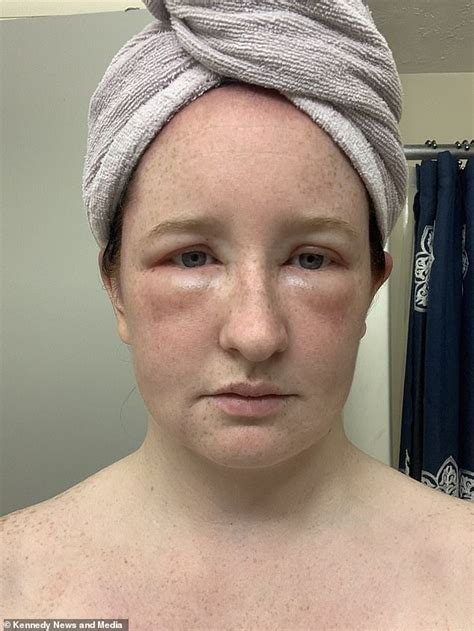 Woman 26 Reveals Allergic Reaction To Hair Dye Left Her With Chemical