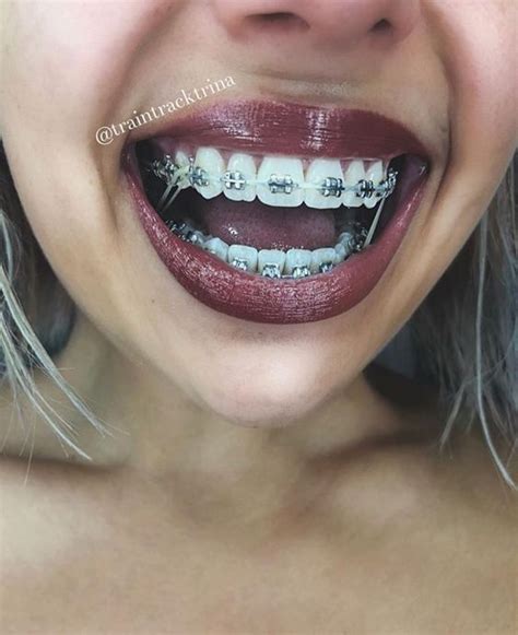 pin by elpotrillo31 on mouth braces dental braces brace face teeth braces