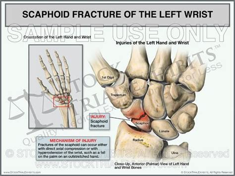 Scaphoid Fracture Of The Left Wrist Medical Exhibit Scaphoid Fracture