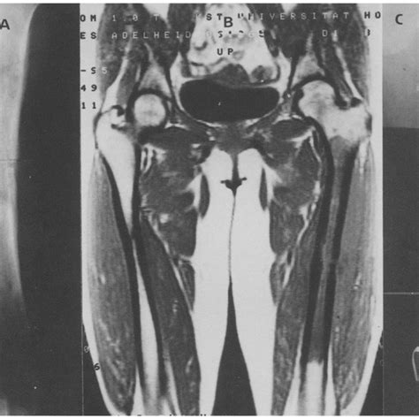 Case 3 A Radiograph Anteroposterior View Of The Left Femur Shows
