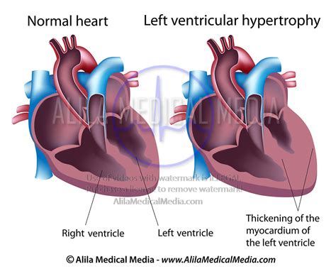 Alila Medical Media Hypoplastic Left Heart Syndrome Medical