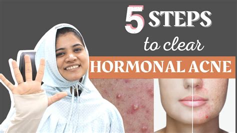 5 Steps To Heal Hormonal Acne Cure Hormonal Acne Pcos Acne Youtube