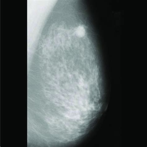 Malignant Cancerous Mammogram Download Scientific Diagram