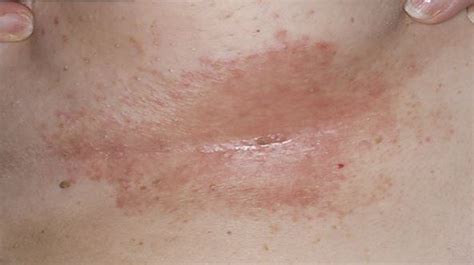 Rash Under Breast Pictures Get Rid Of Sore Heat Rash From Sweat