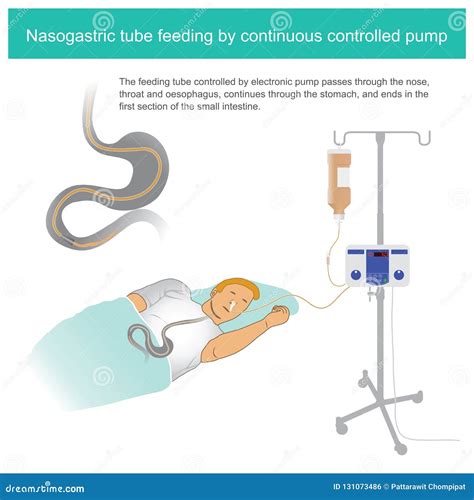 Nasogastric Tube Feeding By Continuous Controlled Pump 25x25 Stock