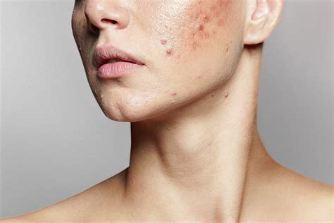 Spironolactone For Acne Efficacy Benefits And Potential Side Effects